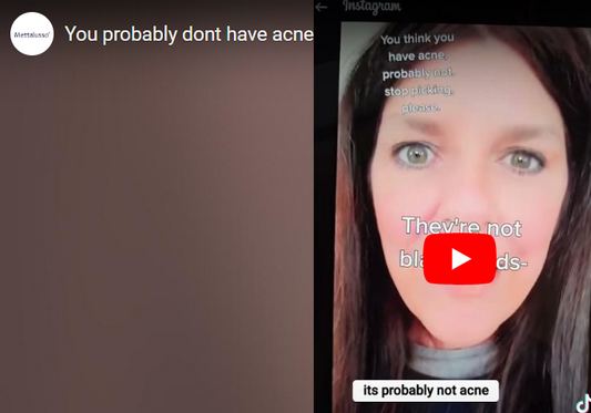 Mettalusso explains why you probably don't have acne and what sebaceous filaments are and why we need them