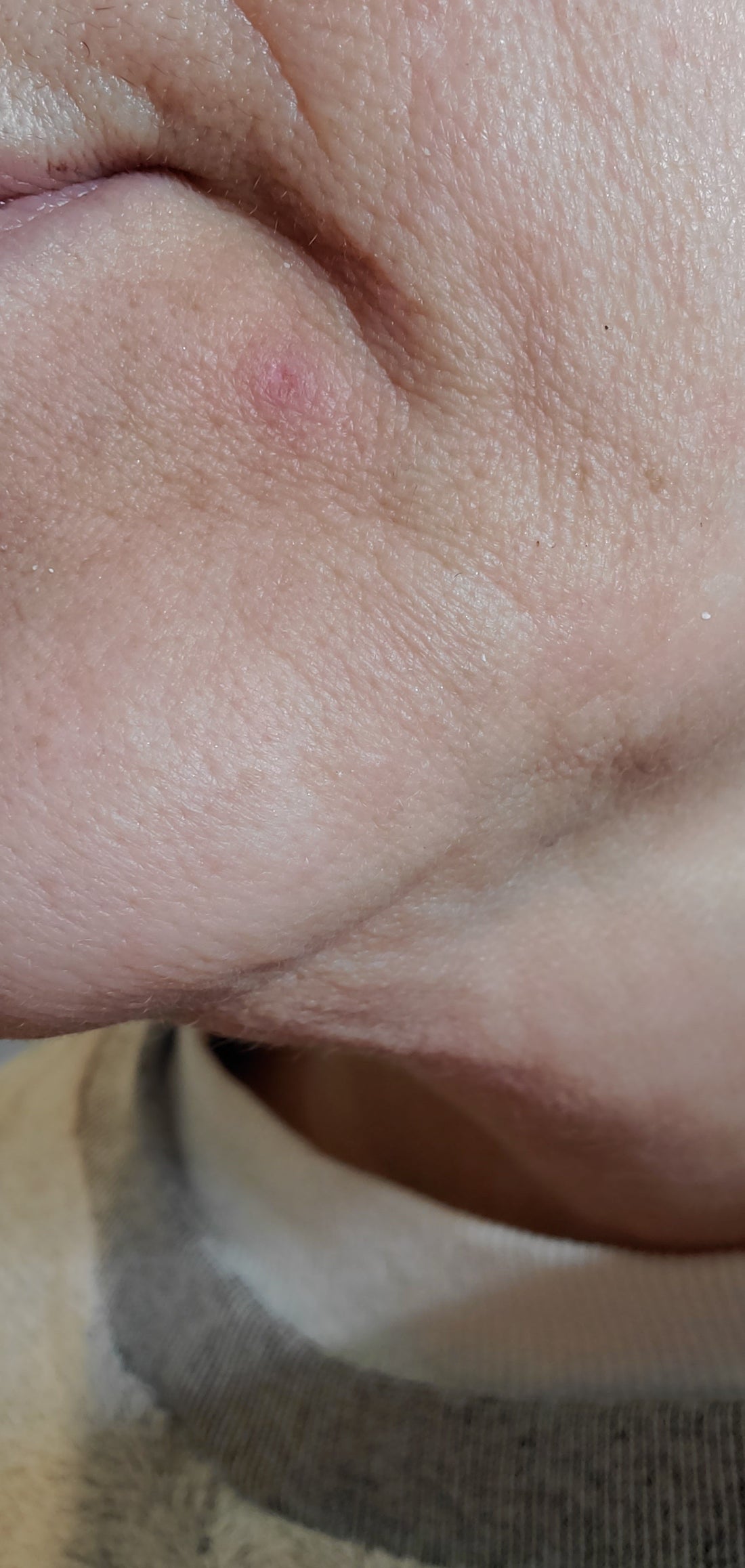 Does your acne treatment work this fast