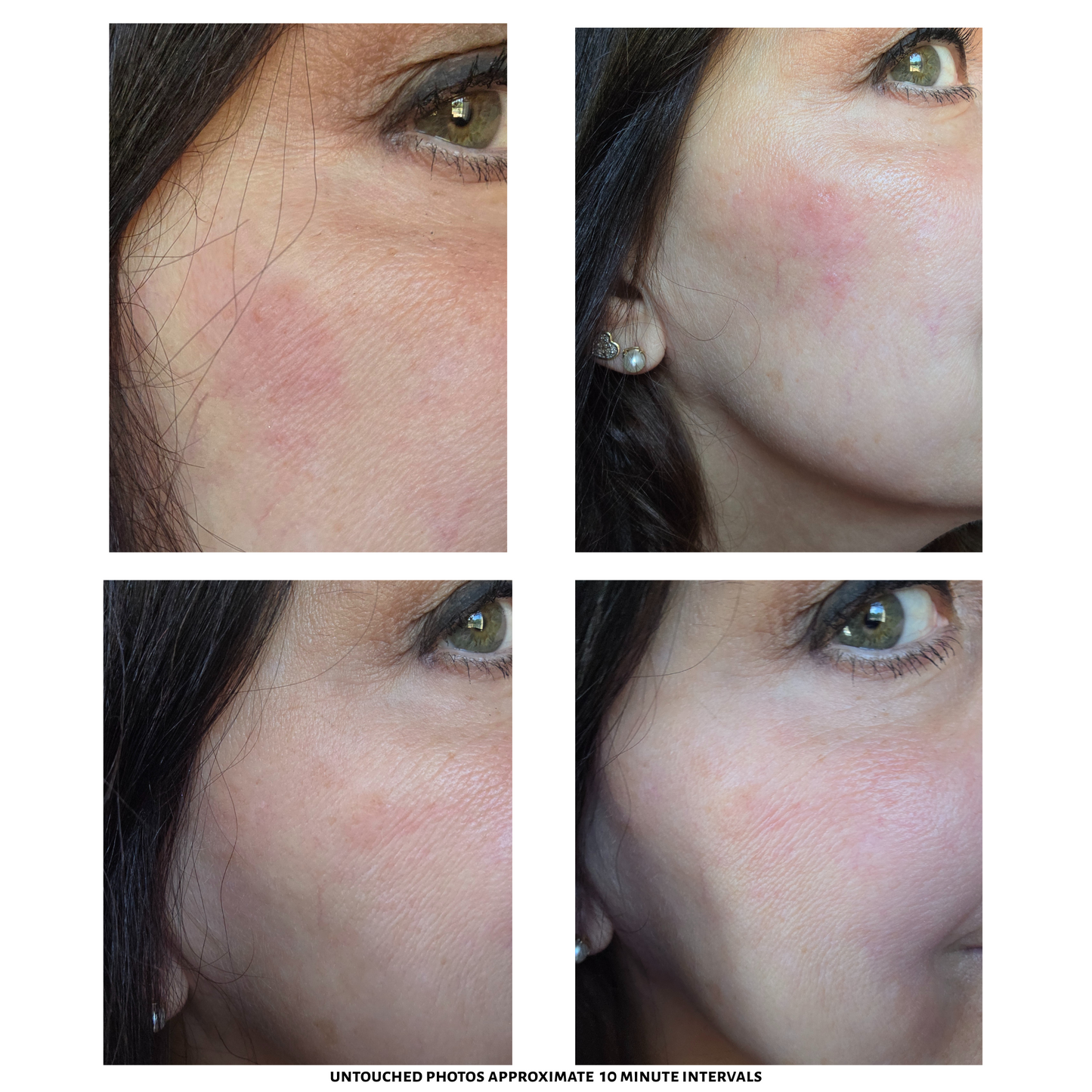 Mettalusso MORIIS vegan OTC Modern Relief  Lotion acts instant calming but very gentle soothes for anti inflammation redness and itching as a lightweight lotion for sensitive skin women and men