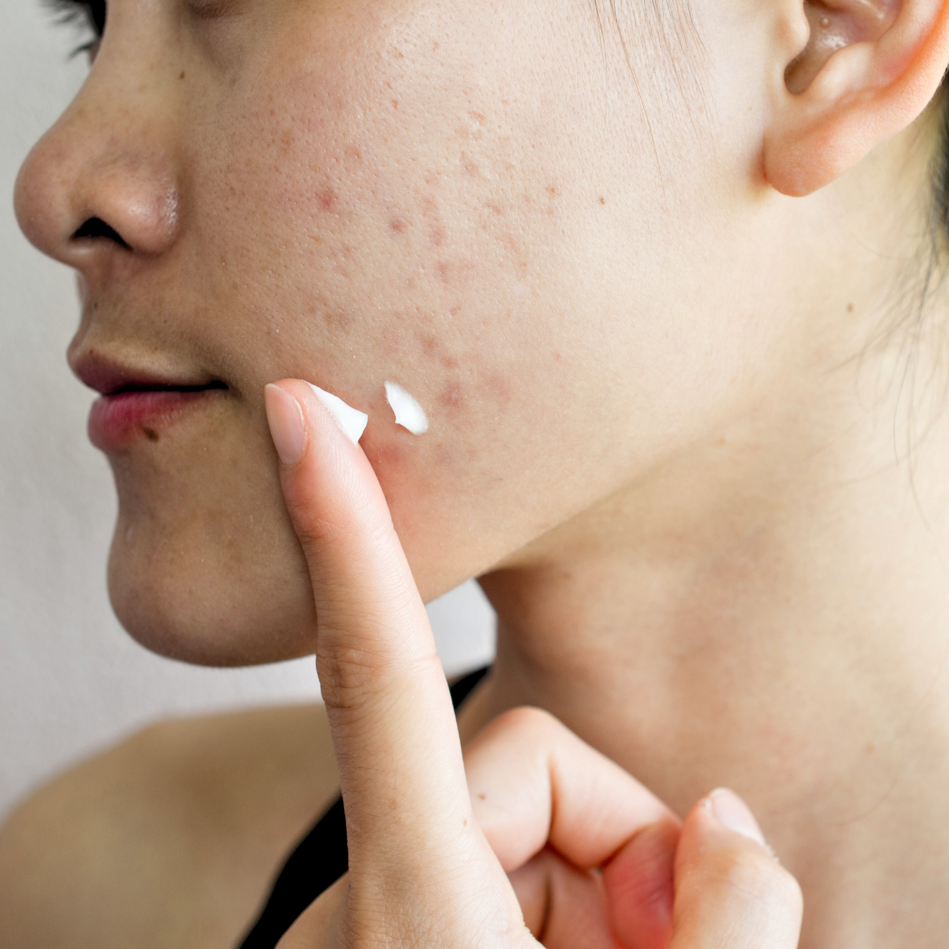 Mettalusso MORIIS vegan OTC acne fighting and anti-aging skincare spot treat or apply all over